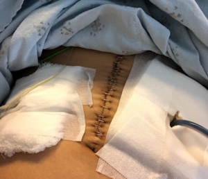 Camilla Row - post stomach cancer surgery torso picture